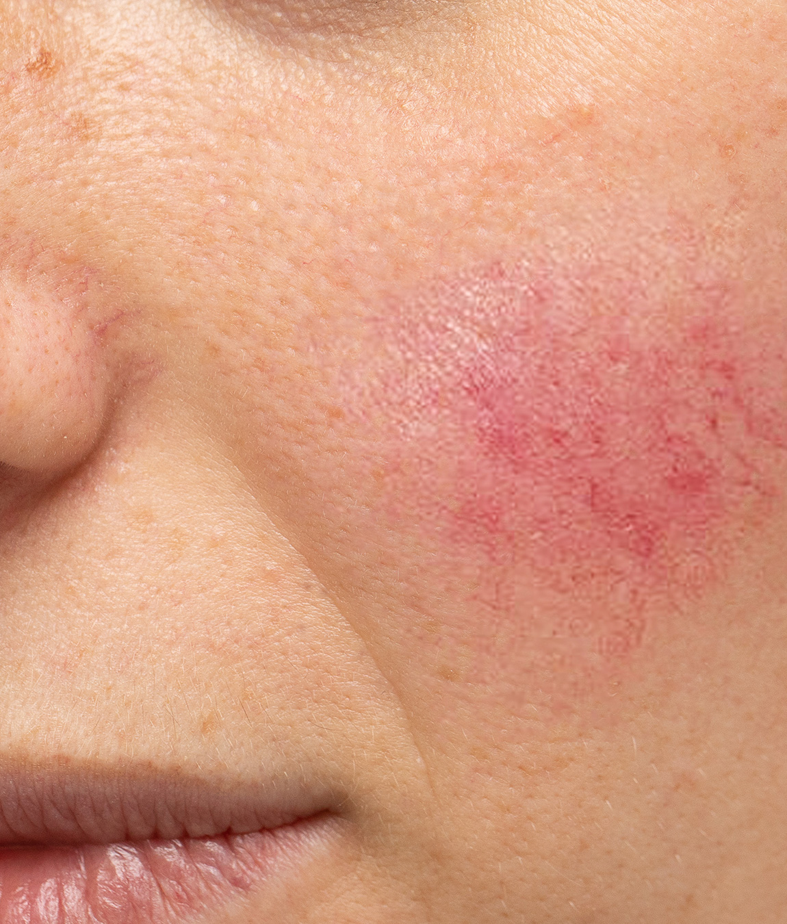 Close-up on rosacea