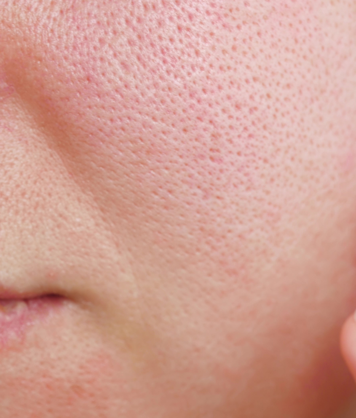 Close-up on enlarged pores