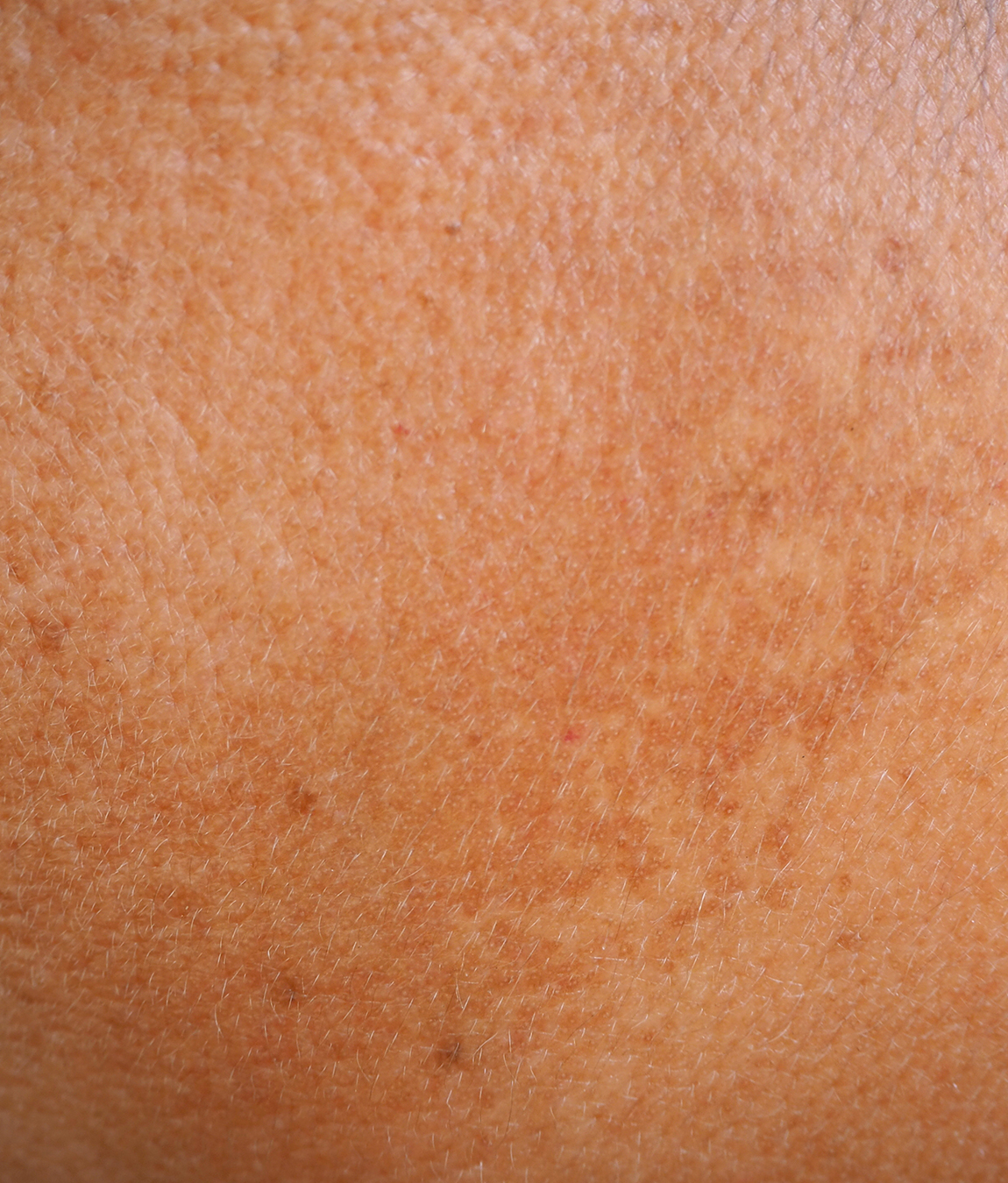 Close-up on sun damage